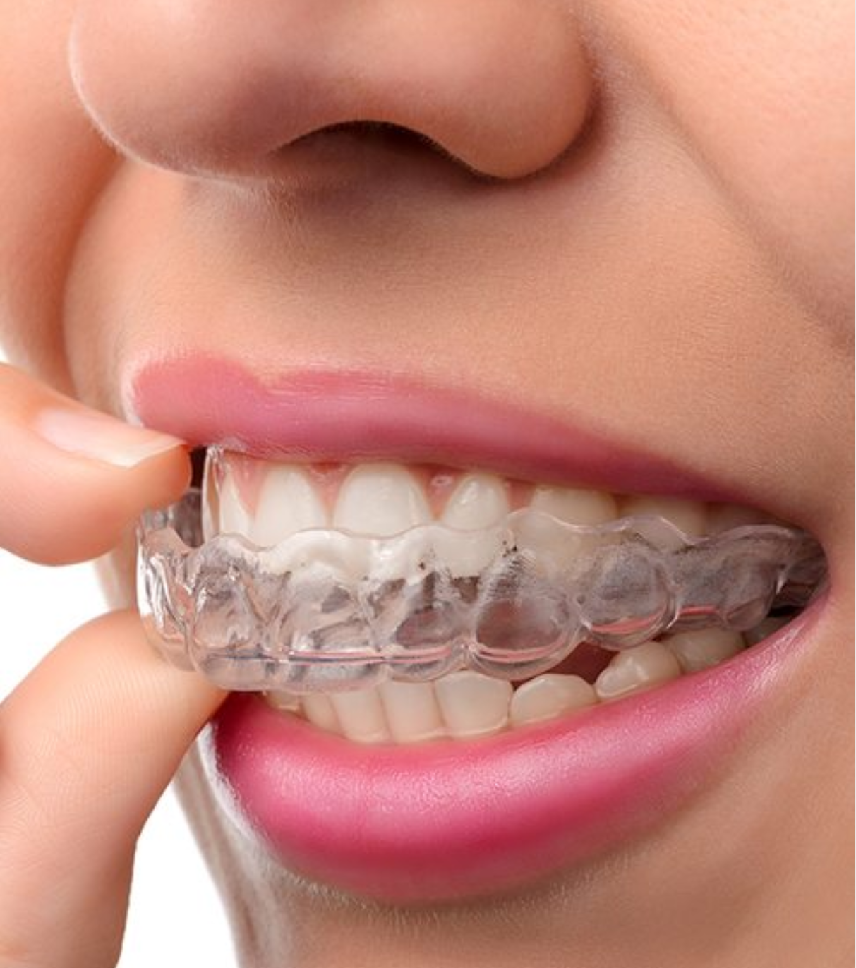 Clear Aligners Orthodontics South Waterfront Dental