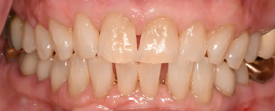 10AfterTeethWhitening
