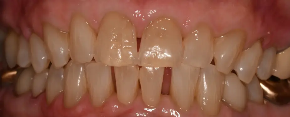 10BEFORETeethWhitening