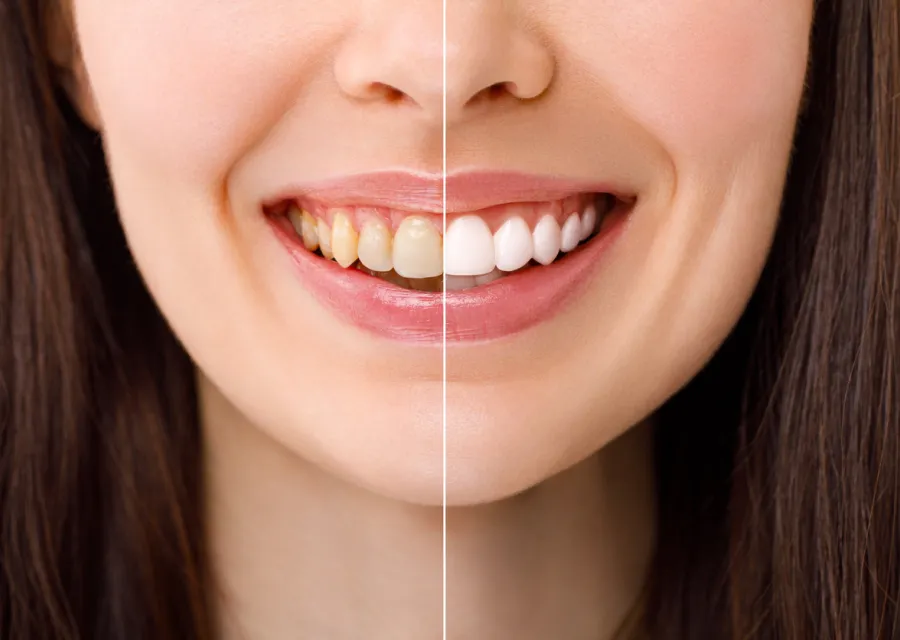 img why choose us for teeth whitening